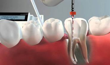 درمان روت کانال دندان